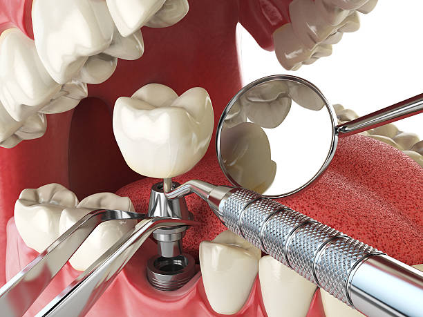 Best Emergency Root Canal Treatment in St James, MD